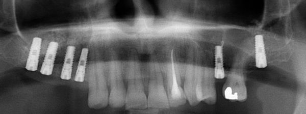 Sinus lift Brno 4 - zubní implantáty