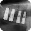 Sinus lift Brno 4 ico