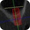 Sinus lift Brno