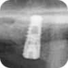 Sinus lift Brno - Zubní implantáty x2