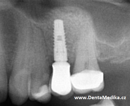 Sinus lift Brno - implantáty X6