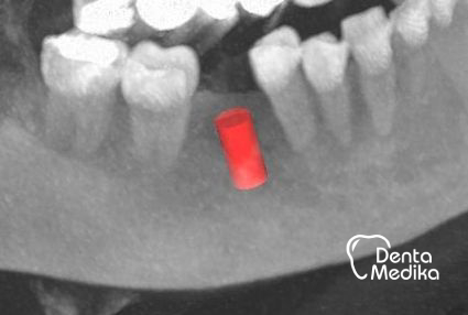 Split čelistní kosti před implantací - DentaMedika Brno _1