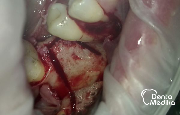 Split čelistní kosti před implantací - DentaMedika Brno _3