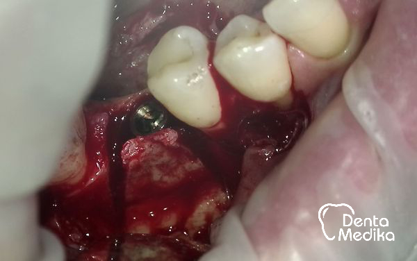 Split čelistní kosti před implantací - DentaMedika Brno _4
