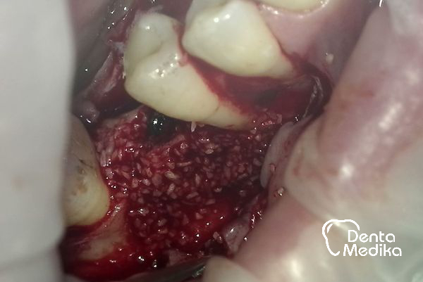 Split čelistní kosti před implantací - DentaMedika Brno _5