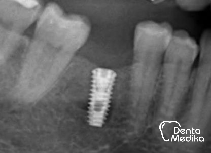 Split čelistní kosti před implantací - DentaMedika Brno _6