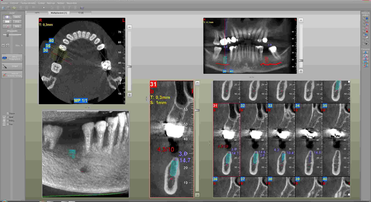 Zubní CBCT (3D-CT) - NewTom Giano Brno