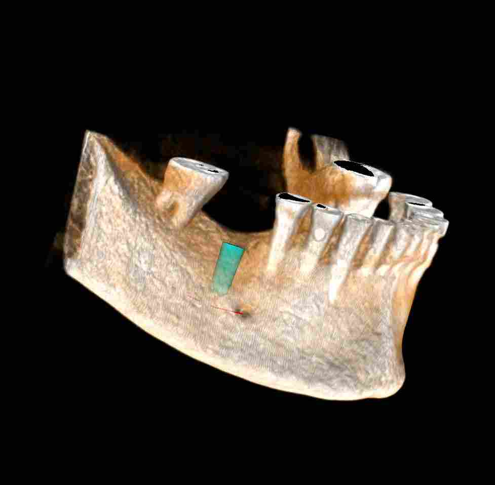Zubní CBCT (3D-CT) - NewTom Giano Brno_1
