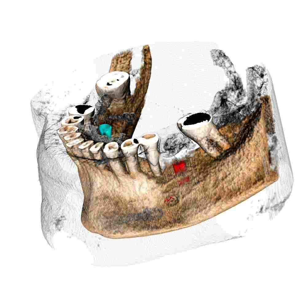 Zubní CBCT (3D-CT) - NewTom Giano Brno_2