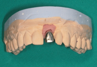 Zubní implantáty Brno 1_5 model