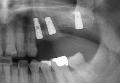 Zubní implantáty Brno 11 - šroubované / lepené, sinus lift, augmentace, 3D CT 2
