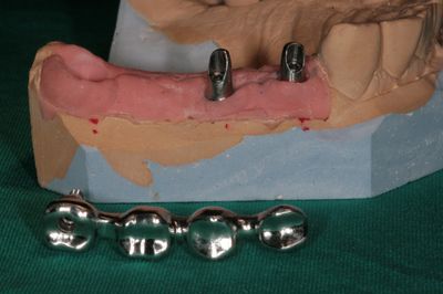 Zubní implantáty Brno 11 - šroubované / lepené, sinus lift, augmentace, 3D CT 4
