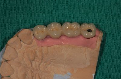 Zubní implantáty Brno 11 - šroubované / lepené, sinus lift, augmentace, 3D CT 5