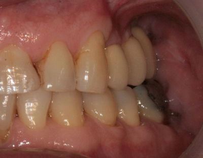 Zubní implantáty Brno 11 - šroubované / lepené, sinus lift, augmentace, 3D CT 6