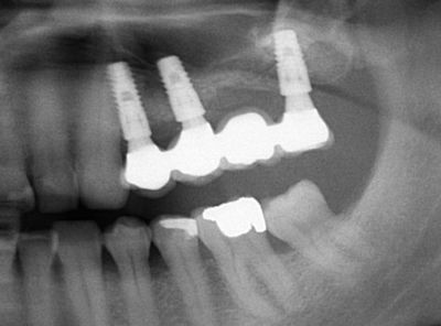 Zubní implantáty Brno 11 - šroubované / lepené, sinus lift, augmentace, 3D CT 7