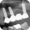  Zubní implantáty Brno - Příklad 11 Šroubovaná/lepená práce, augmentace, sinus lift, frézovaná konstrukce Náhrada horních zubů 4, 5, 6, 7