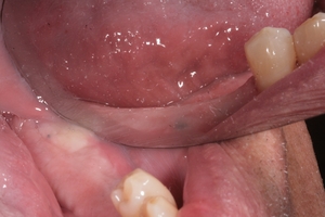 Zubní implantáty Brno - příklad 5_1