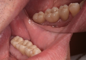Zubní implantáty Brno - příklad 5_2