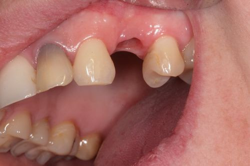 Zubní implantát Brno _ premolár_1