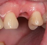 Zubni implantaty Brno mezera