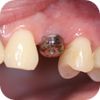 Zubní implantáty Brno - 8