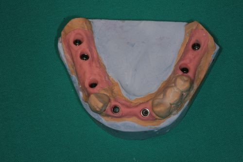 Zubní implantáty Brno - Branemarkuv můstek 3