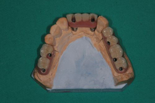 Zubní implantáty Brno - Branemarkuv můstek 4