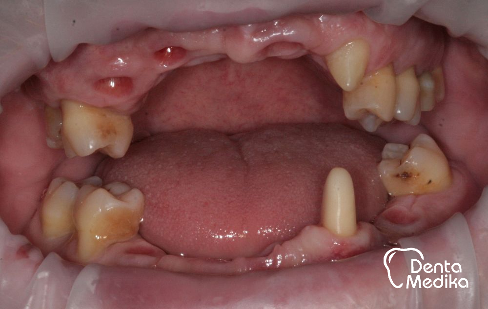 Zubní implantáty Brno - DentaMedika 16-1