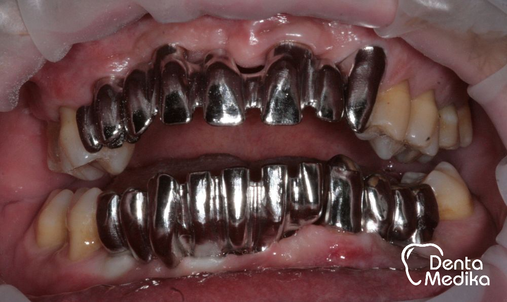 Zubní implantáty Brno - DentaMedika_16-2