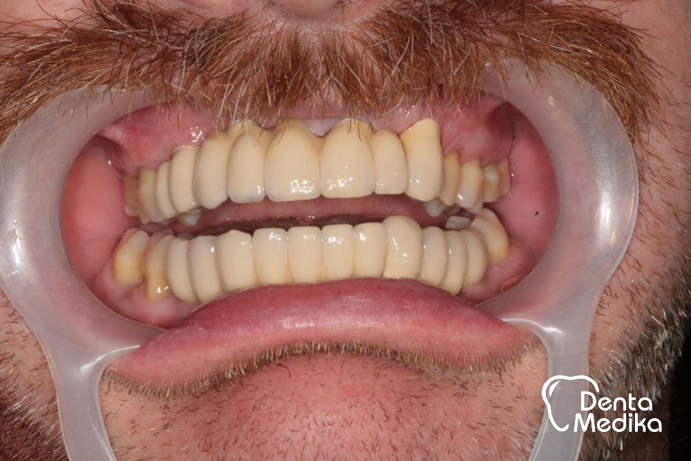 Zubní implantáty Brno - DentaMedika_16-3