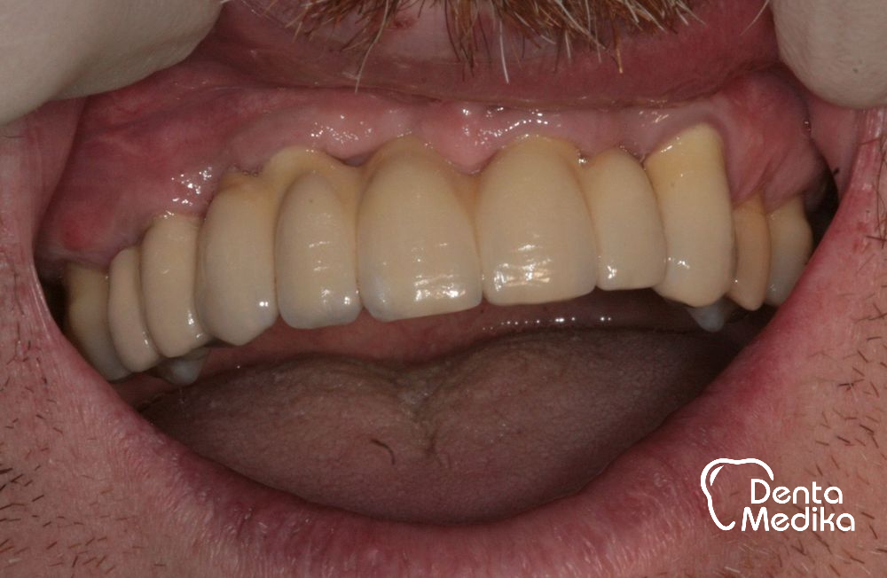 Zubní implantáty Brno - DentaMedika_16-4