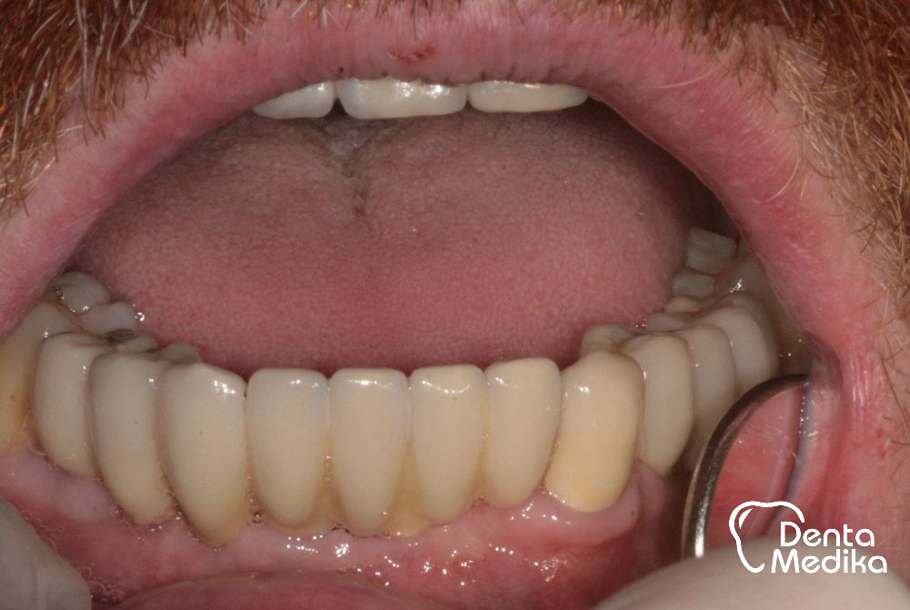 Zubní implantáty Brno - DentaMedika_16-5