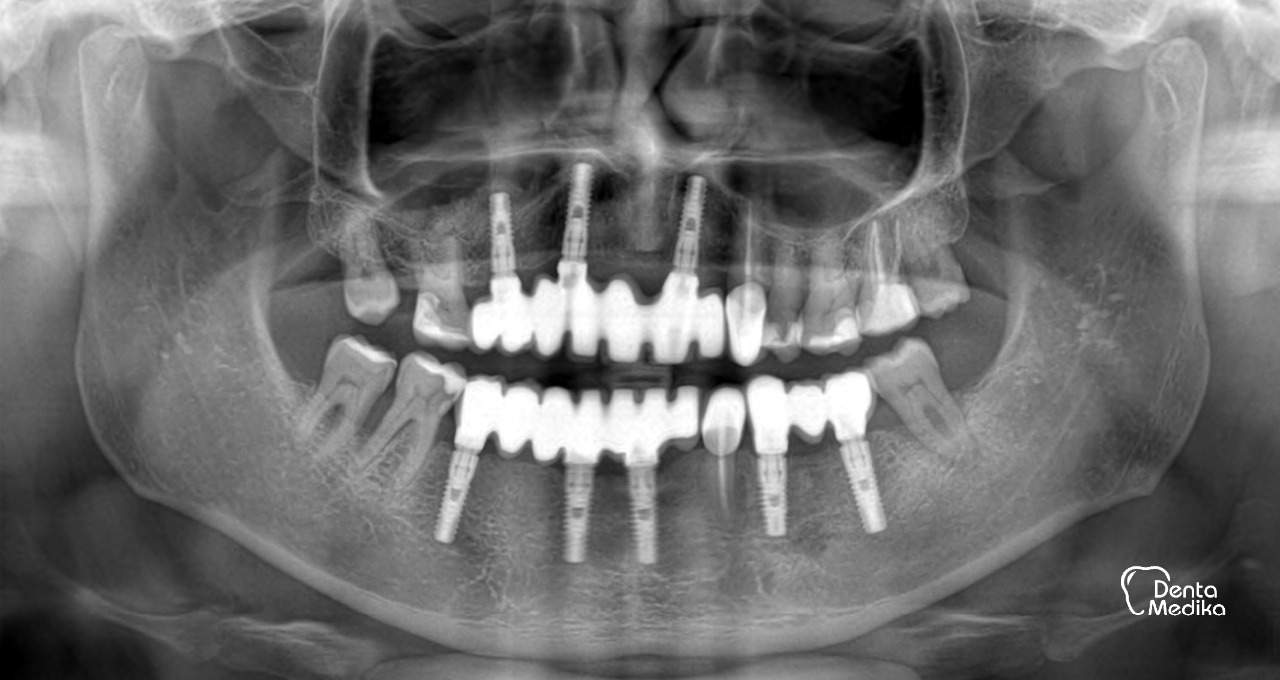 Zubní implantáty Brno - DentaMedika_16-7