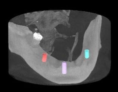 Zubní implantáty Brno 9 - hybridní náhrada 3