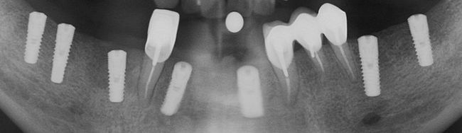 Zubní implantáty Brno - sedm fixtur