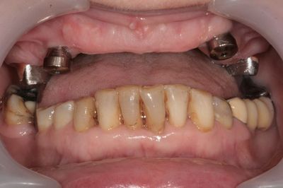 Zubní implantáty Brno -  Využití LOCATORŮ 10_2