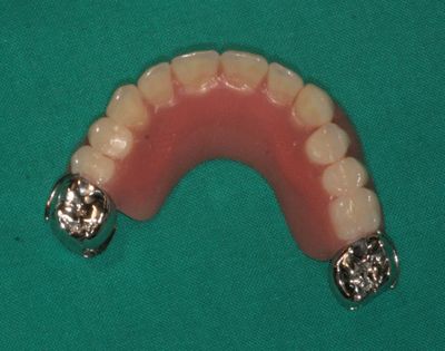 Zubní implantáty Brno -  Využití LOCATORŮ 10_3