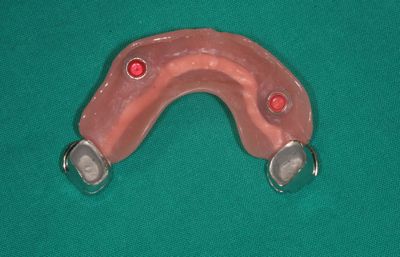 Zubní implantáty Brno -  Využití LOCATORŮ 10_4