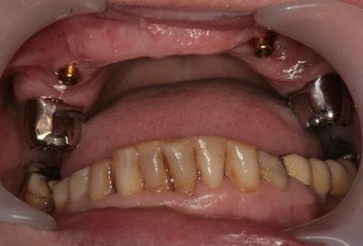 Zubní implantáty Brno -  Využití LOCATORŮ 10_5