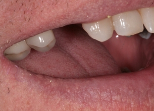 Zubní implantáty Brno - příklad 4_1