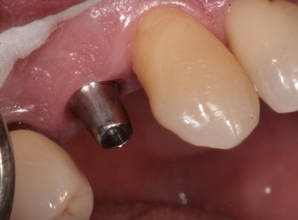 Zubní implantáty Brno - příklad 4_2