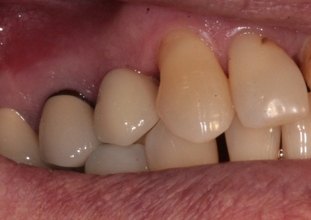 Zubní implantáty Brno - příklad 4_4
