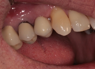 Zubní implantáty Brno - příklad 4_3