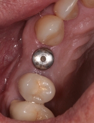 Zubní implantáty Brno - příklad 4_5
