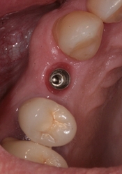 Zubní implantáty Brno - příklad 4_6