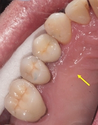 Zubní implantáty Brno - příklad 4_7