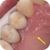 Zubní implantáty - horní čtyřka