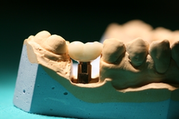 Metalokeramická korunka na implantátu - laboratorní model