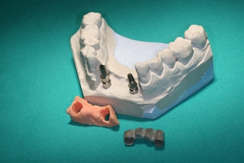 Zubní implantáty Brno - model pro přední můstek