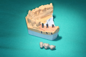 Implantáty Brno - tři abutmenty - nástavby